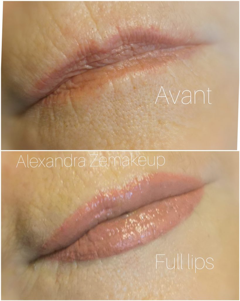 Full lips avant/après