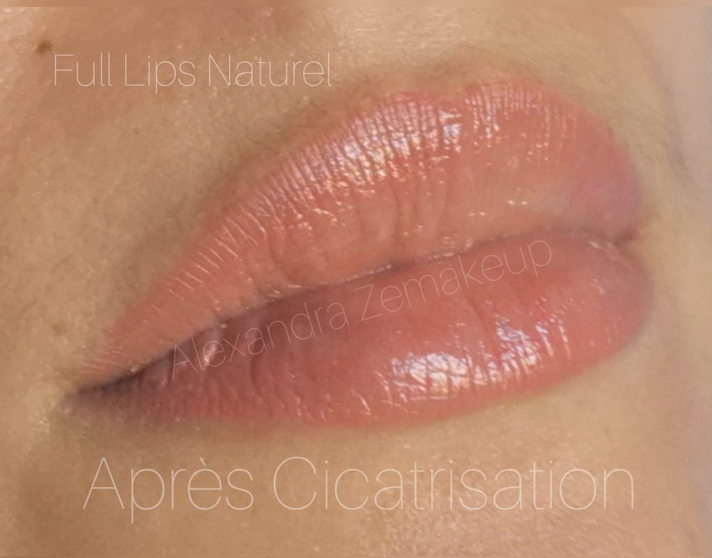 full lips naturel après cicatrisation